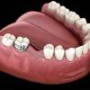 Mantenedores de Espacio Dental