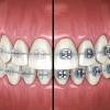 Brackets Carámicos